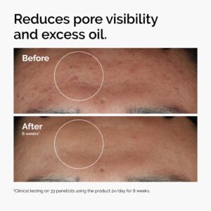The Ordinary Niacinamide 10% + Zinc 1% Serum – 30 mL - Image 3