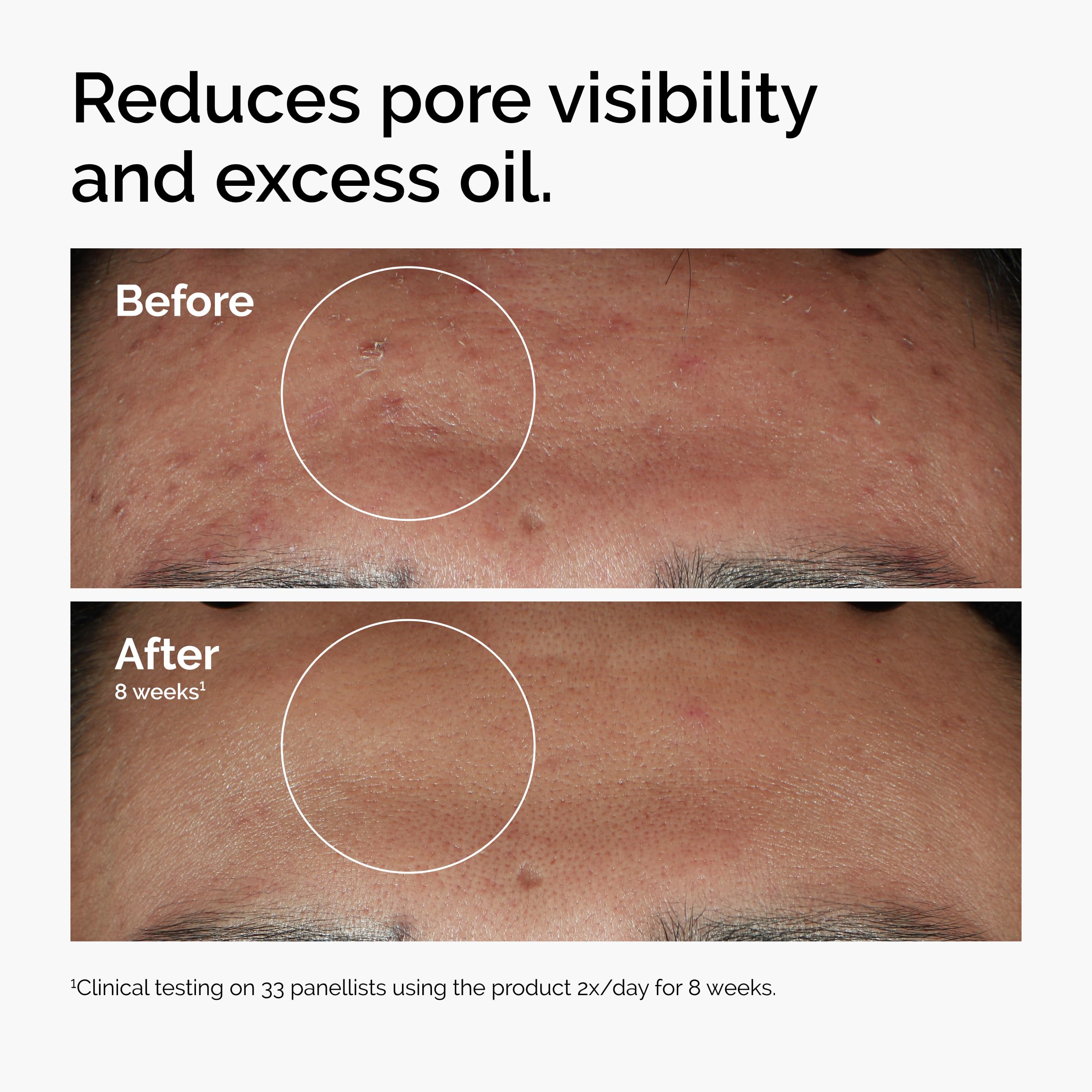 The Ordinary Niacinamide 10% + Zinc 1% Serum – 30 mL - Image 3